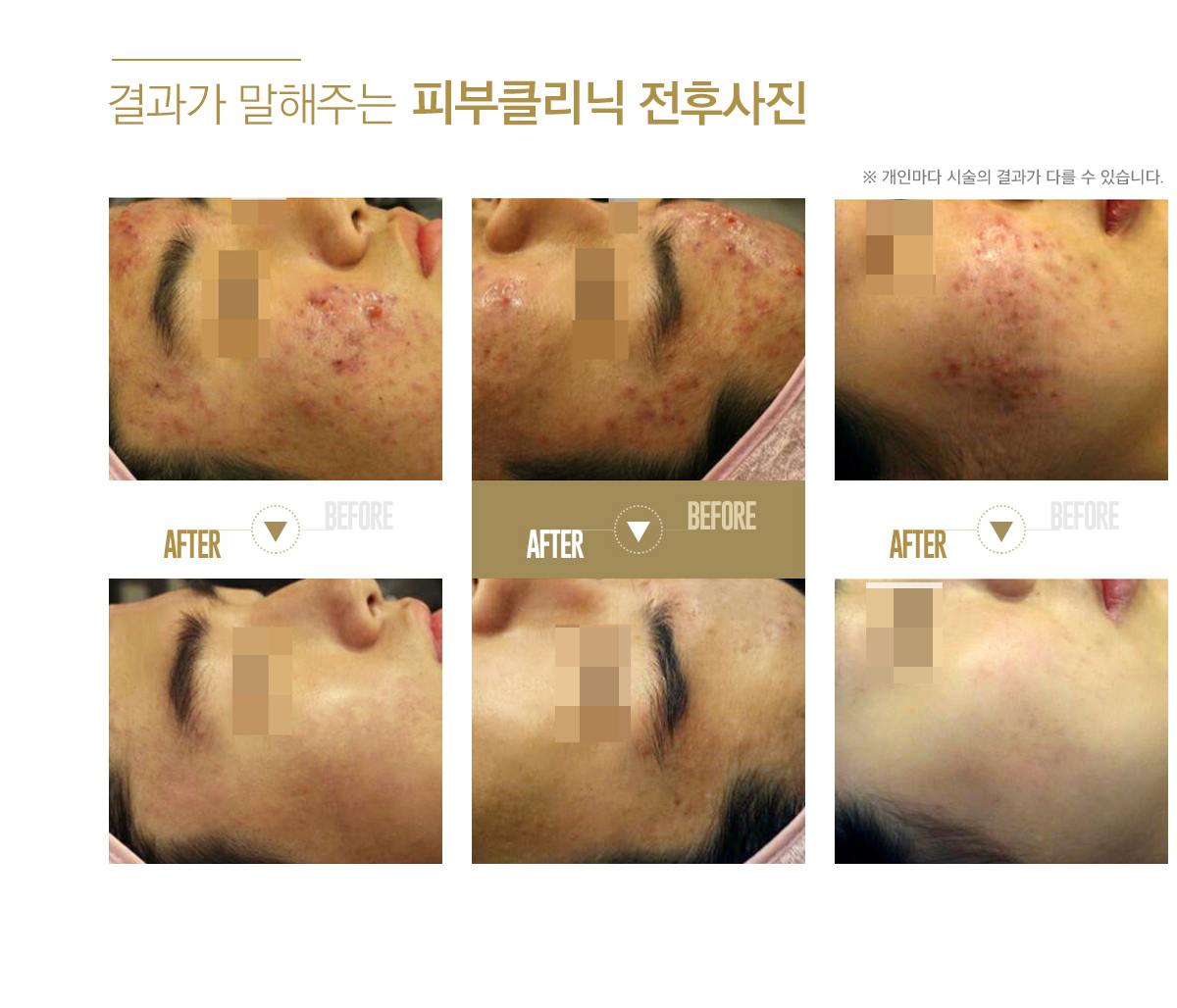 Agarophil – Acne & Pores